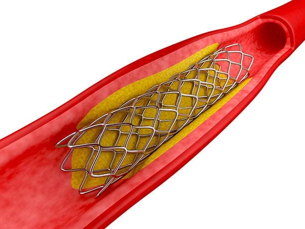 An illustration of a stent creating space for blood flow within a blocked vessel.
